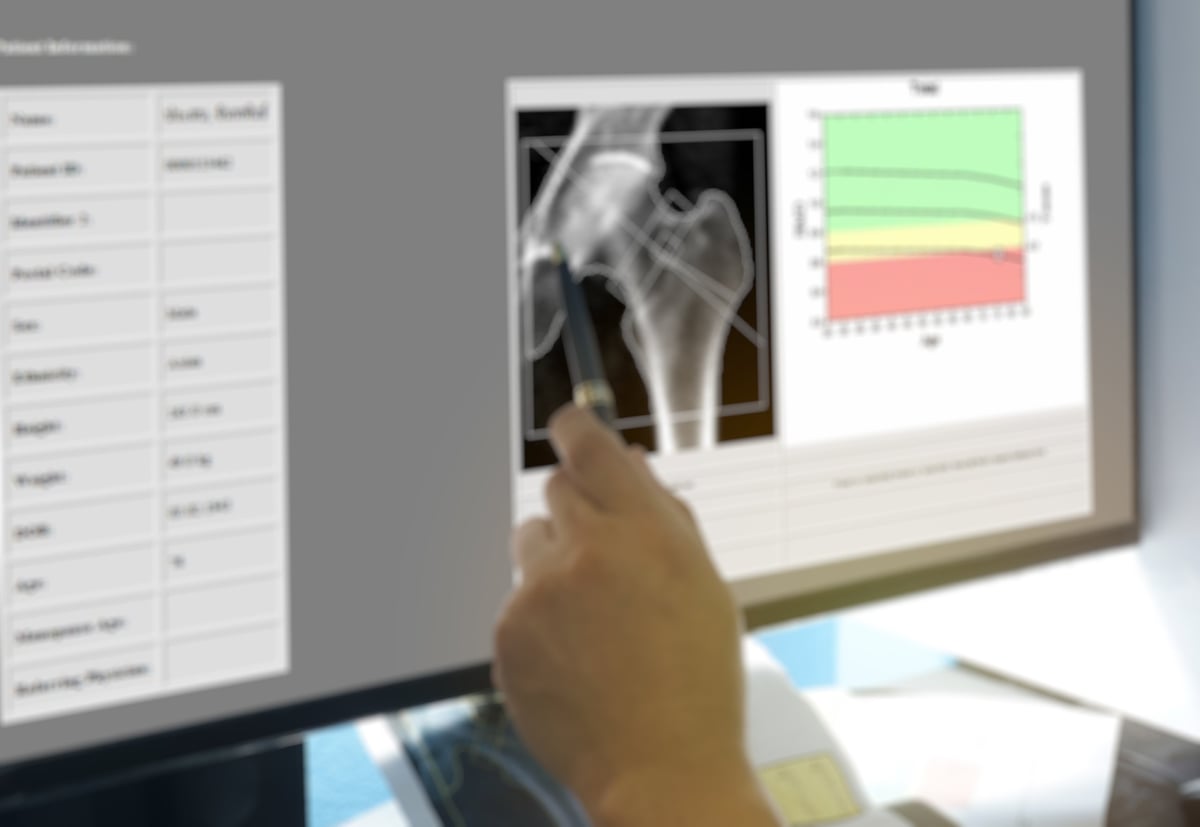 Doctor indicating the position of osteoporosis in the hips on a bright background